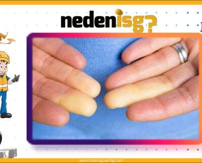 Titreşime Bağlı Beyaz Parmak Hastalığı