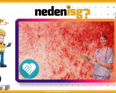 Cilt Kanseri Yapan Maddeler ve İşler